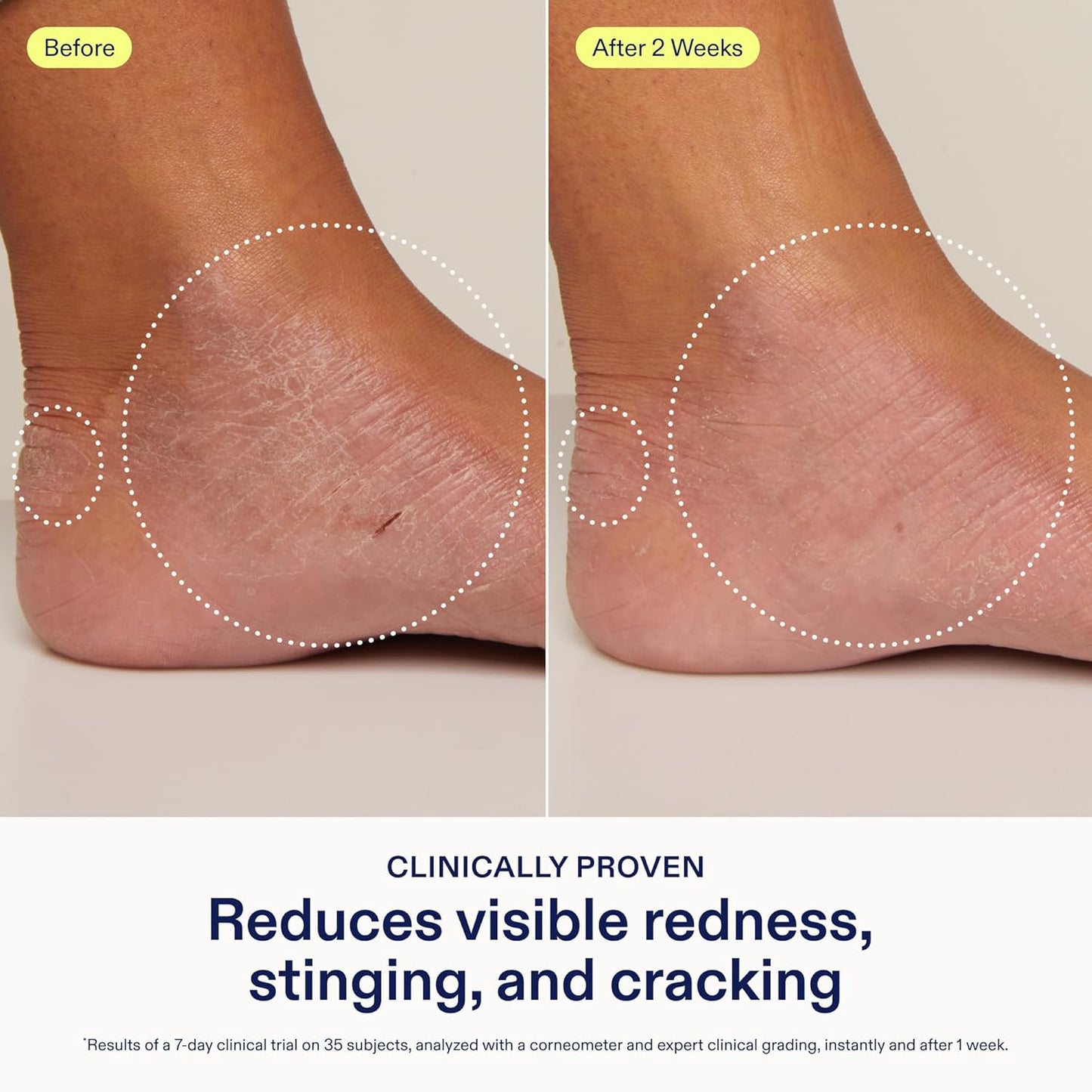 Skinfix Hand Relief Cream - 3 fl oz - Reduces Visible Redness, Stinging & Cracking for Dry, Sensitive Skin - Accepted by the National Eczema Association - Fragrance Free - Vegan, Cruelty Free